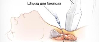 лечение многоузлового зоба