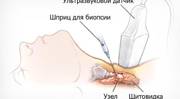 лечение многоузлового зоба