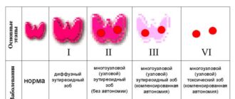 степени зоба щитовидной железы